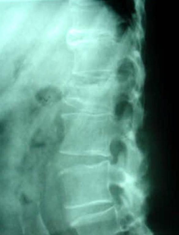 compression fracture
